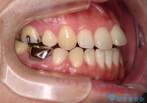 【モニター】舌のトレーニングを行いながら後戻りの再矯正の治療前