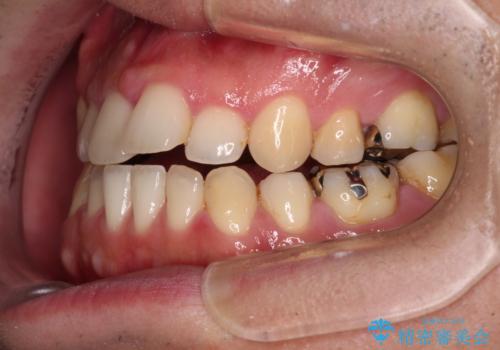 【モニター】舌のトレーニングを行いながら後戻りの再矯正の治療前