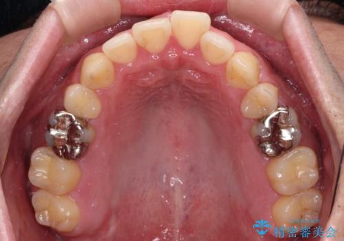 【モニター】舌のトレーニングを行いながら後戻りの再矯正の治療前