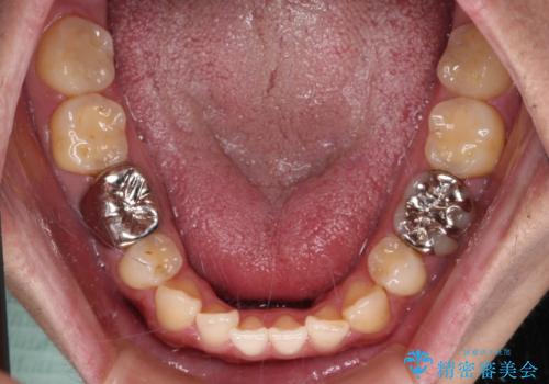 【モニター】舌のトレーニングを行いながら後戻りの再矯正の治療前