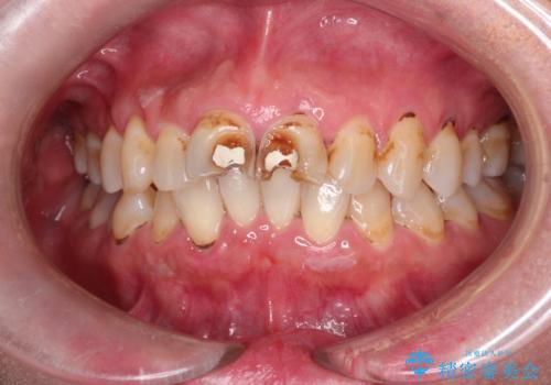 詰め物が突然とれたの症例 治療前