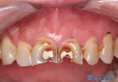 詰め物が突然とれたの治療前