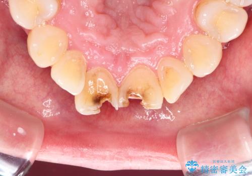 詰め物が突然とれたの治療前