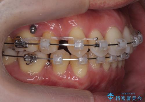出っ歯をしっかり引っ込めたいの治療中