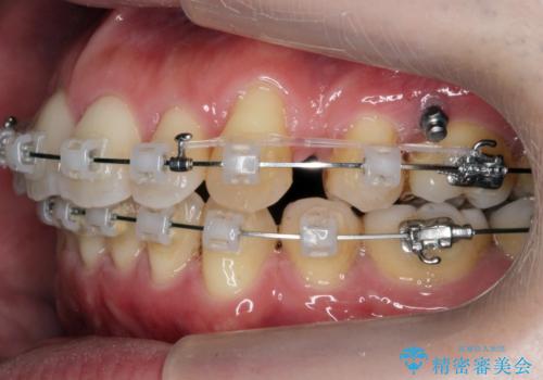 出っ歯をしっかり引っ込めたいの治療中