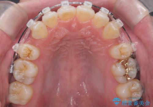 出っ歯をしっかり引っ込めたいの治療中