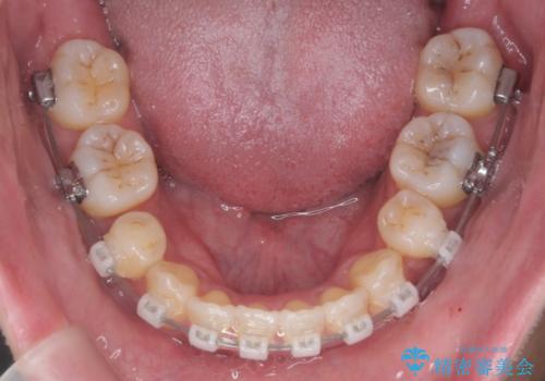 出っ歯をしっかり引っ込めたいの治療中