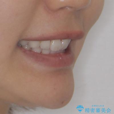 尖った前歯を引っ込めたい 目立たないワイヤー装置での抜歯矯正の治療後(顔貌)