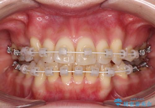 デコボコで磨きにくい歯列 ワイヤー装置での抜歯矯正で歯磨きをしやすくの治療中