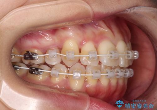 デコボコで磨きにくい歯列　ワイヤー装置での抜歯矯正で歯磨きをしやすくの治療中