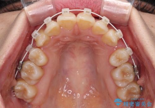 デコボコで磨きにくい歯列 ワイヤー装置での抜歯矯正で歯磨きをしやすくの治療中