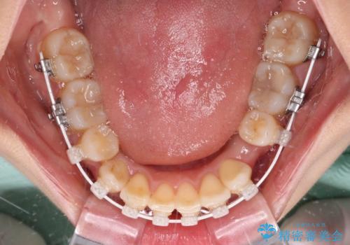 デコボコで磨きにくい歯列　ワイヤー装置での抜歯矯正で歯磨きをしやすくの治療中