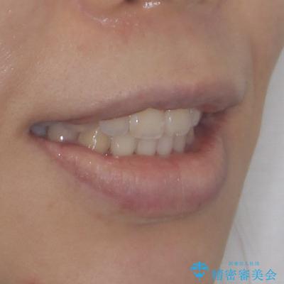 気がつくと唇が開く 口元を下げる抜歯矯正の治療後(顔貌)