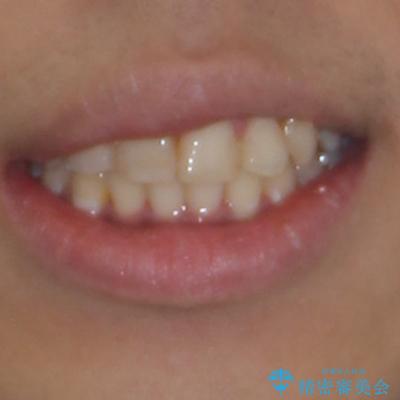 八重歯と開咬　ワイヤー装置での抜歯矯正の治療後（顔貌）