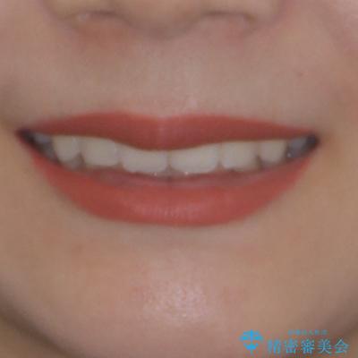 目立たない裏側装置 ハーフリンガルの抜歯矯正の治療後(顔貌)