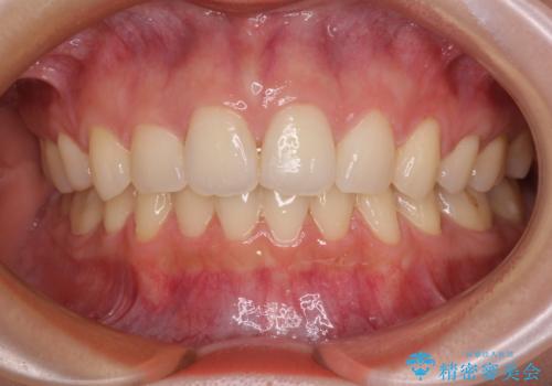 目立たない裏側装置 ハーフリンガルの抜歯矯正の症例 治療後