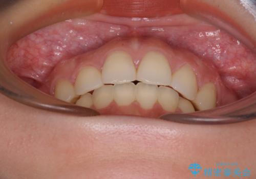 目立たない裏側装置 ハーフリンガルの抜歯矯正の治療後