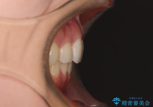 目立たない裏側装置 ハーフリンガルの抜歯矯正の治療後