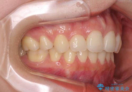 目立たない裏側装置 ハーフリンガルの抜歯矯正の治療後