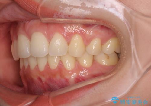 目立たない裏側装置 ハーフリンガルの抜歯矯正の治療後