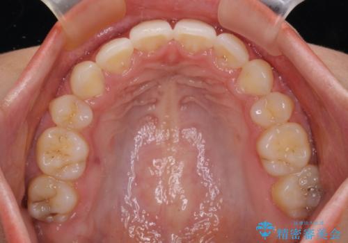 目立たない裏側装置 ハーフリンガルの抜歯矯正の治療後