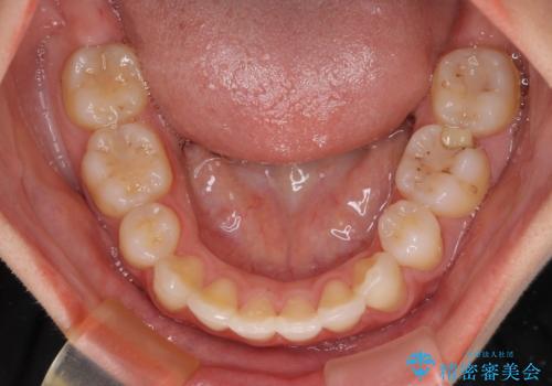 目立たない裏側装置 ハーフリンガルの抜歯矯正の治療後