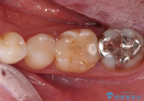 欠けてしまった奥歯 セラミッククラウンとセラミックインレーによるむし歯治療の治療前