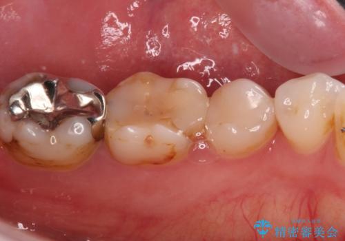 欠けてしまった奥歯 セラミッククラウンとセラミックインレーによるむし歯治療の治療前