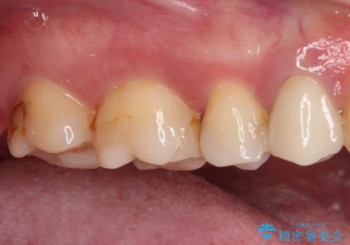 欠けてしまった奥歯 セラミッククラウンとセラミックインレーによるむし歯治療の治療前