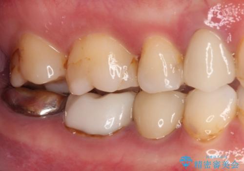 欠けてしまった奥歯 セラミッククラウンとセラミックインレーによるむし歯治療の治療前