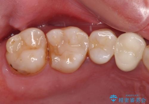 欠けてしまった奥歯 セラミッククラウンとセラミックインレーによるむし歯治療の症例 治療前