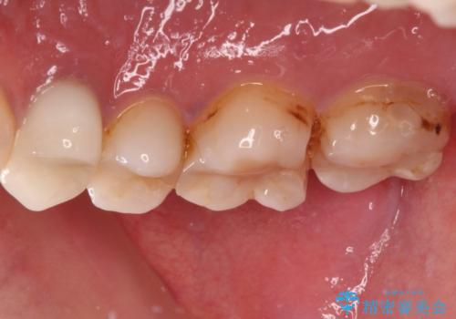 欠けてしまった奥歯 セラミッククラウンとセラミックインレーによるむし歯治療の治療前