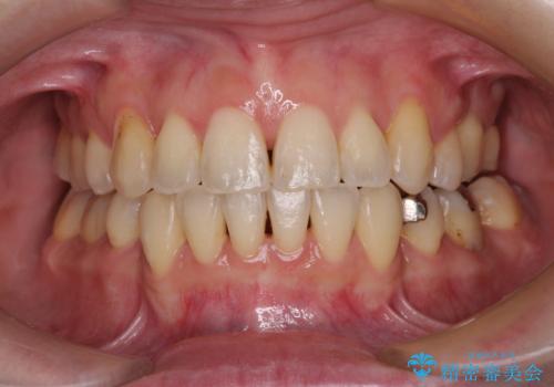 【モニター】上下の八重歯を治したい ワイヤー装置による矯正治療の症例 治療後