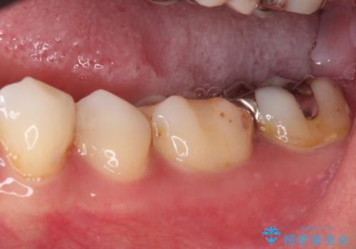 欠けてしまった奥歯 セラミッククラウンとセラミックインレーによるむし歯治療の治療前