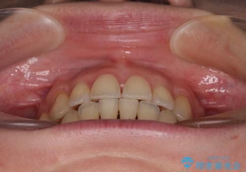 【モニター】上下の八重歯を治したい ワイヤー装置による矯正治療の治療後