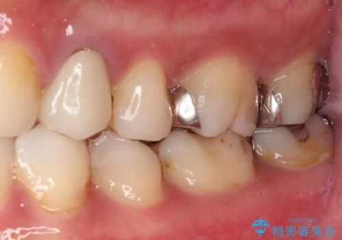 欠けてしまった奥歯 セラミッククラウンとセラミックインレーによるむし歯治療の治療前
