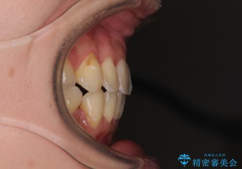 【モニター】上下の八重歯を治したい ワイヤー装置による矯正治療の治療後