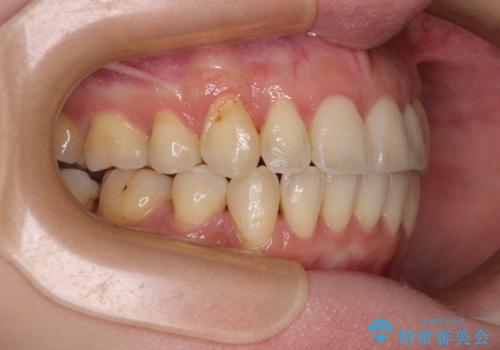 【モニター】上下の八重歯を治したい ワイヤー装置による矯正治療の治療後