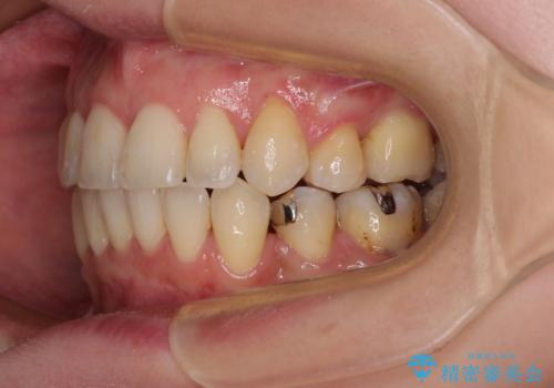 【モニター】上下の八重歯を治したい ワイヤー装置による矯正治療の治療後