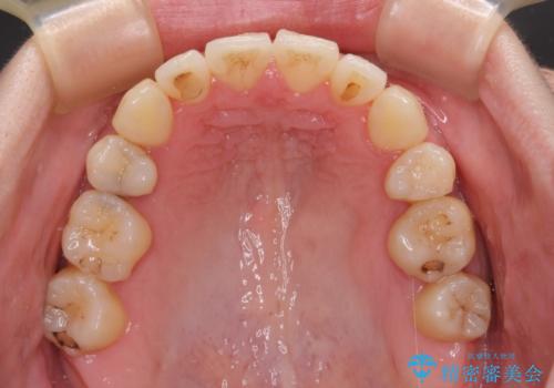 【モニター】上下の八重歯を治したい ワイヤー装置による矯正治療の治療後