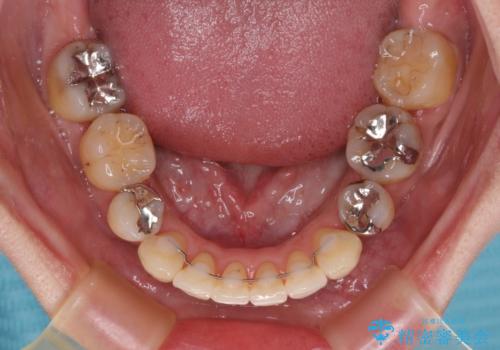 【モニター】上下の八重歯を治したい ワイヤー装置による矯正治療の治療後