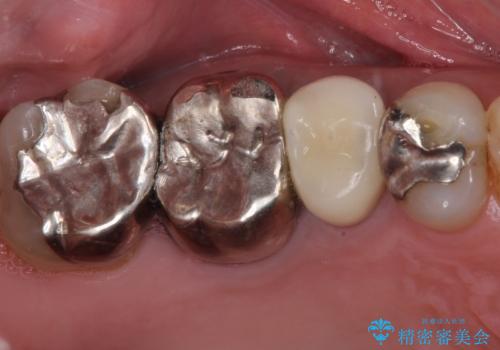 もげてしまった奥歯 オールセラミッククラウンでの補綴治療の症例 治療後