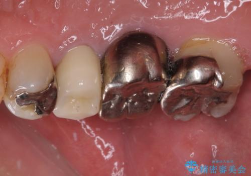もげてしまった奥歯 オールセラミッククラウンでの補綴治療の治療後