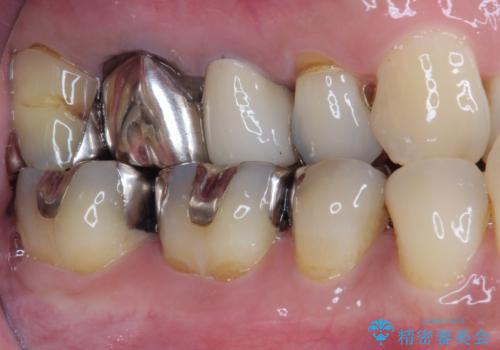 もげてしまった奥歯 オールセラミッククラウンでの補綴治療の治療後