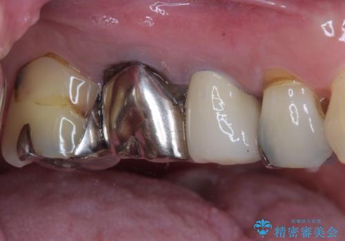 もげてしまった奥歯 オールセラミッククラウンでの補綴治療の治療後