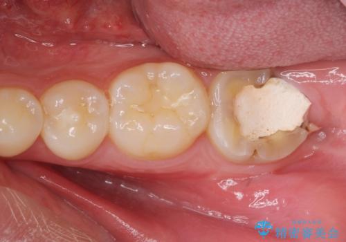 他院での治療に不信感　虫歯除去後のジルコニアクラウンの治療前