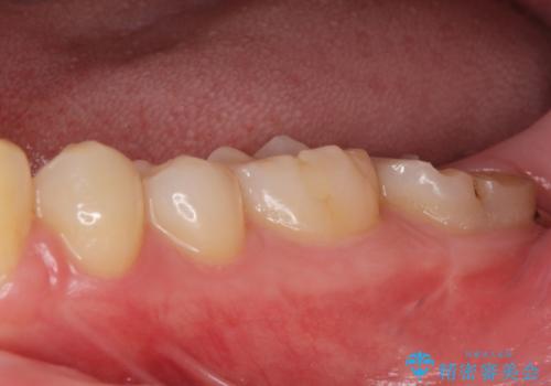 他院での治療に不信感 虫歯除去後のジルコニアクラウンの治療前