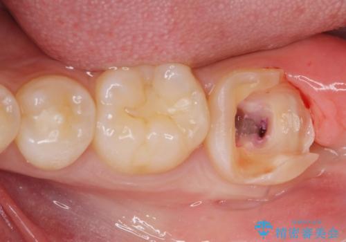 他院での治療に不信感 虫歯除去後のジルコニアクラウンの治療中
