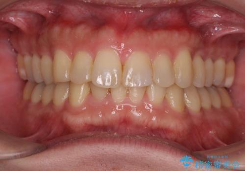 深い咬み合わせで顎が疲れる ワイヤー矯正でディープバイトを解消の症例 治療後