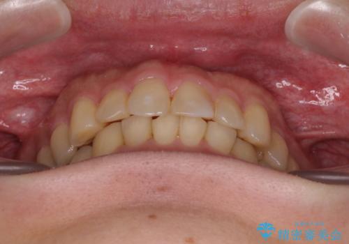 深い咬み合わせで顎が疲れる ワイヤー矯正でディープバイトを解消の治療後